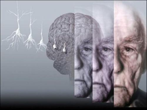 Δωρεάν τεστ για Αλτσχάιμερ στο Ναύπλιο