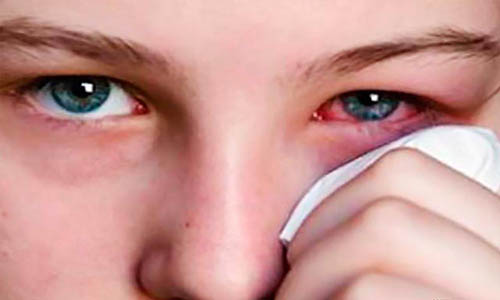 Προσοχή στις αλλεργίες εν όψει Πάσχα συνιστούν οι οφθαλμίατροι